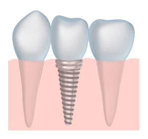 dental implants dentist Belgrade MT